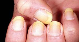 Why do nails turn yellow?