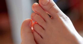 How to prevent yellow toenails?